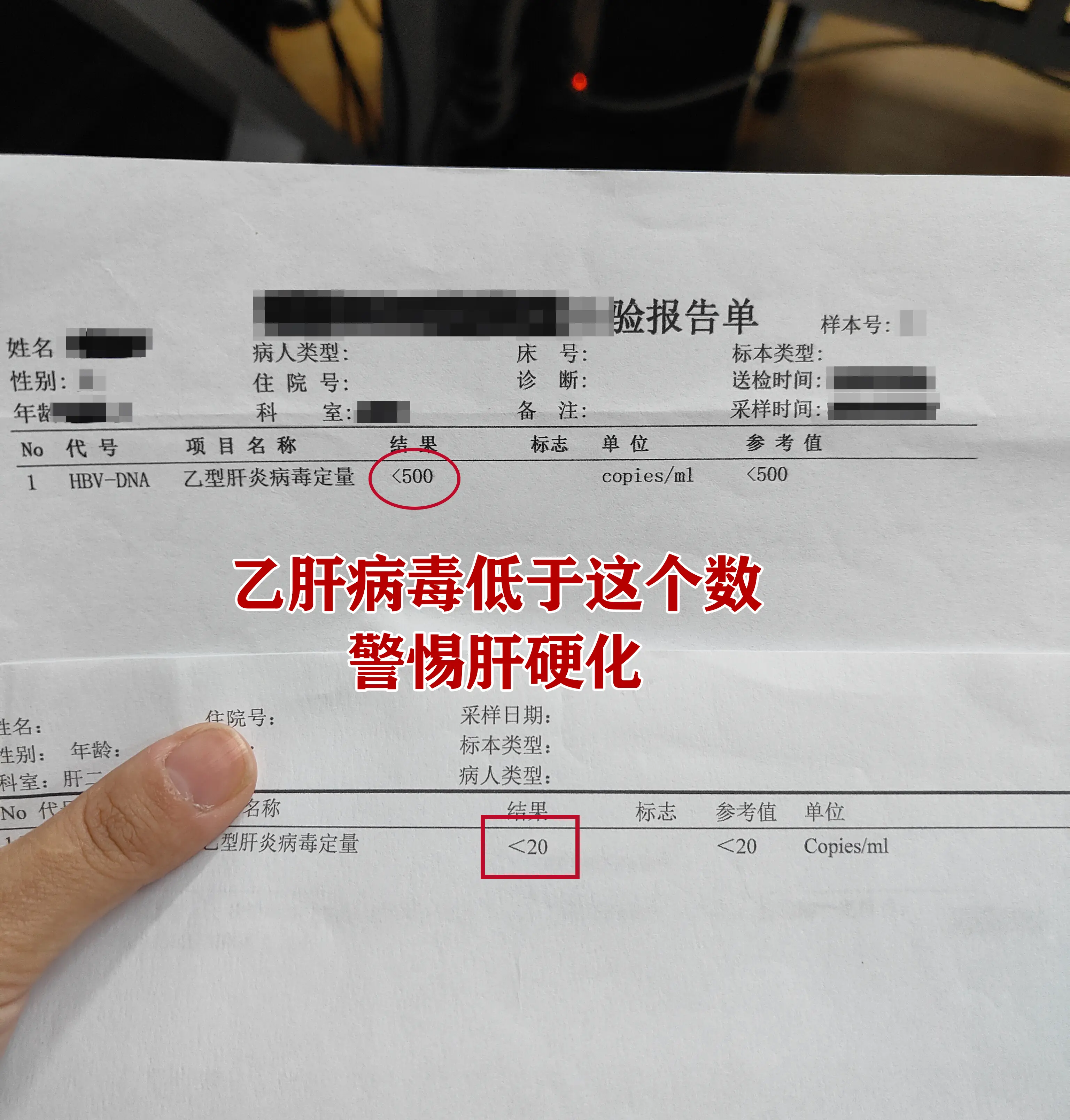 这个在之前的视频中讲过，乙肝病毒量低于500不是终点，化验单上显示转阴...