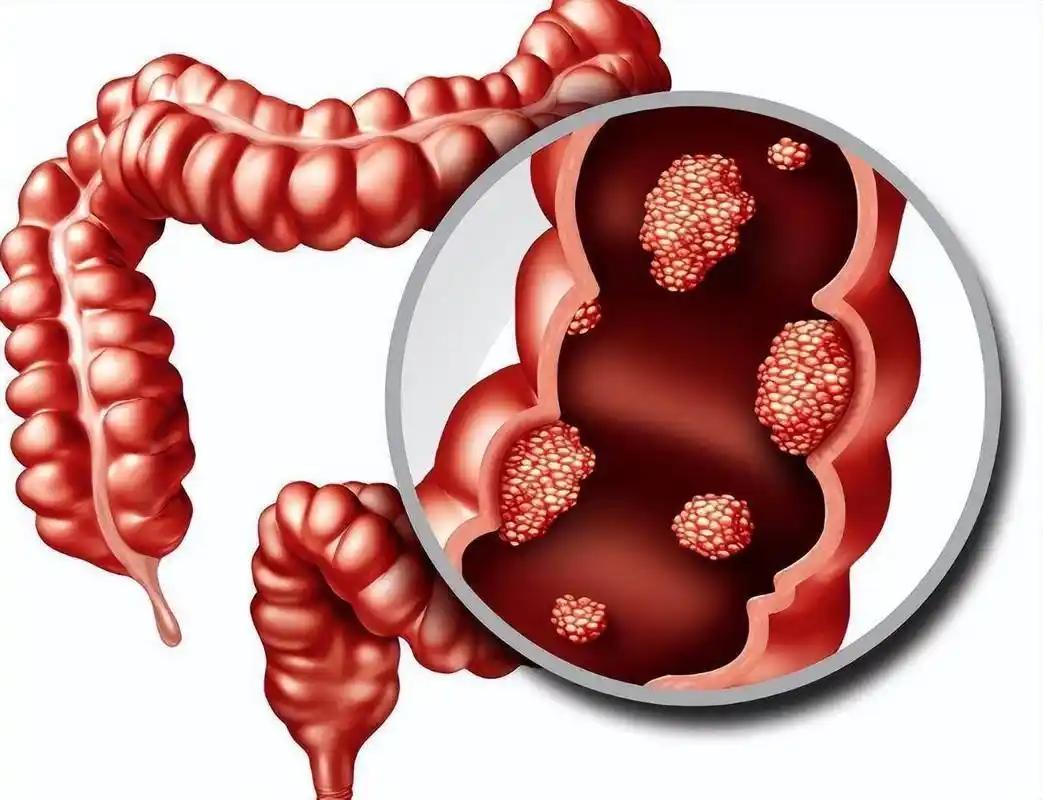 张阿姨今年 62 岁，平时最爱跳广场舞，上个月突然腹痛便血，检查后竟是晚期肠癌，