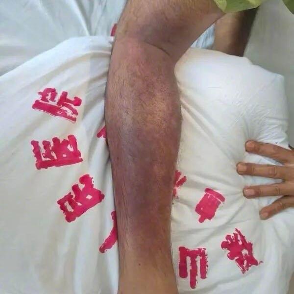 “是个狠人！”云南小伙踩进草丛一脚踩中蛇窝，被3条毒蛇连咬12口，一开始以为是虫