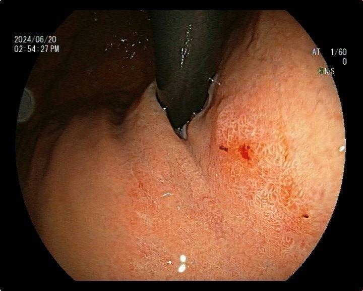 男，60岁，慢性萎缩性胃炎复查。慢性萎缩性胃炎多年，本次复查：贲门下...