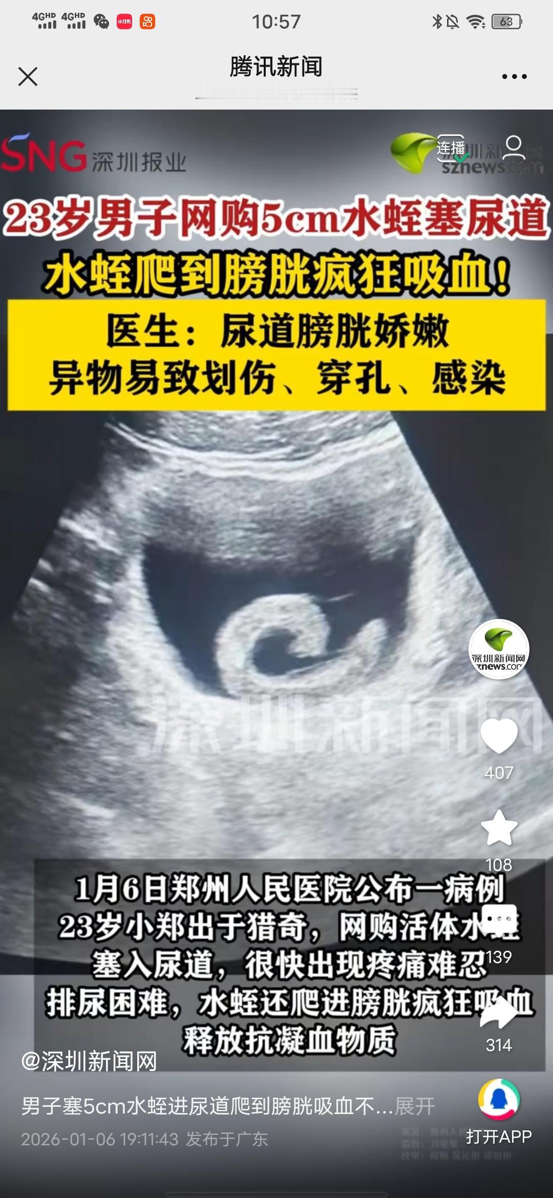 真是旷古奇闻，太奇葩了！

男子塞5cm水蛭进尿道爬到膀胱吸血不止！

来自深圳