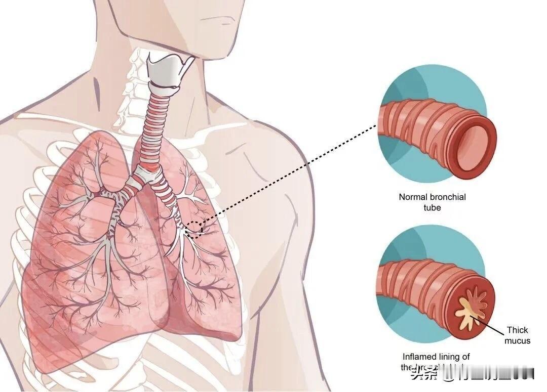 反复咳嗽气喘？5个经典中成药调理慢性支气管炎，温和止咳平喘不刺激，一文读懂
 