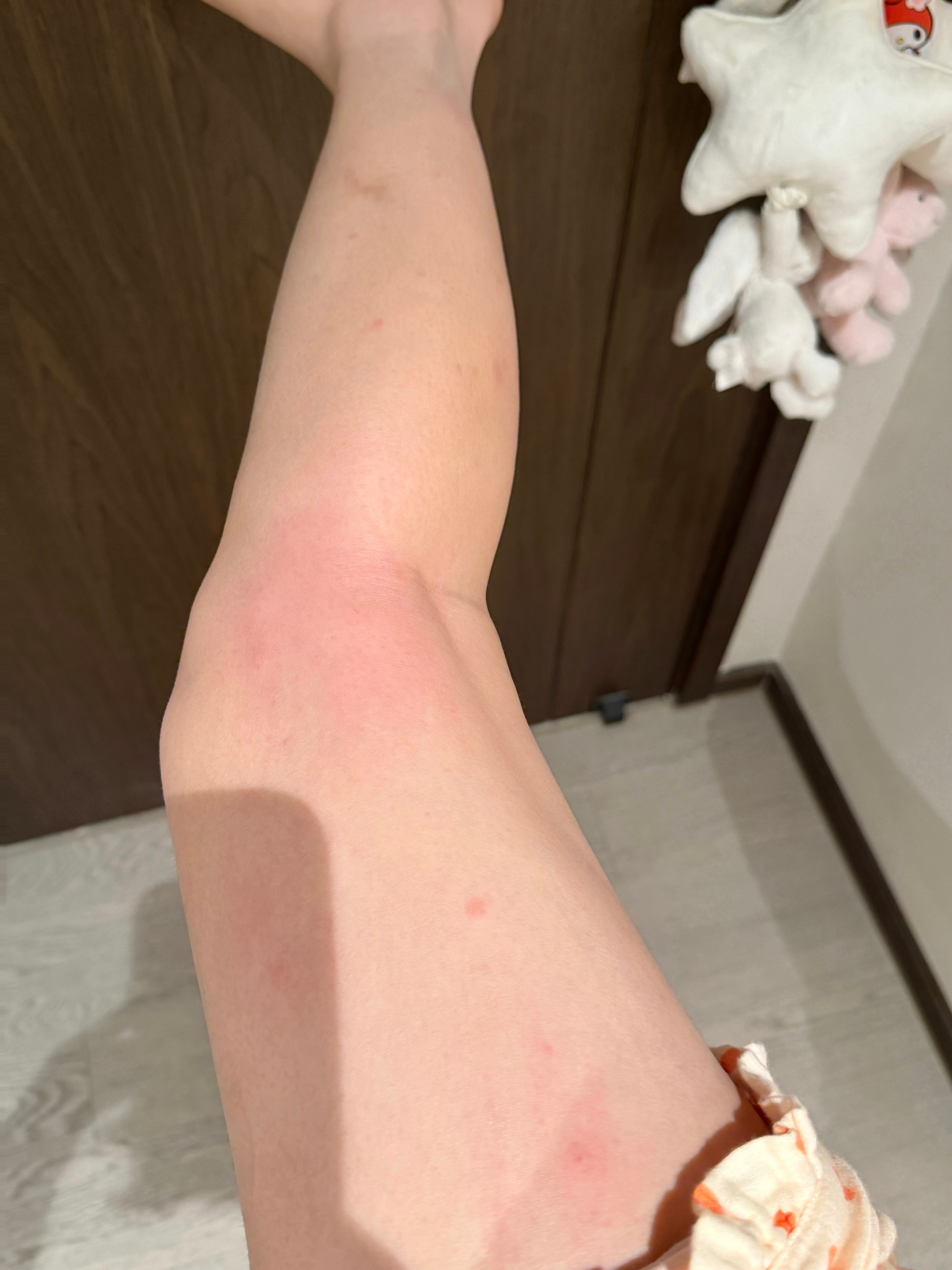 夏天出门拍照真的要喷花露水啊 我的双腿昨天拍视频那会被咬了30个包 到今天这些红