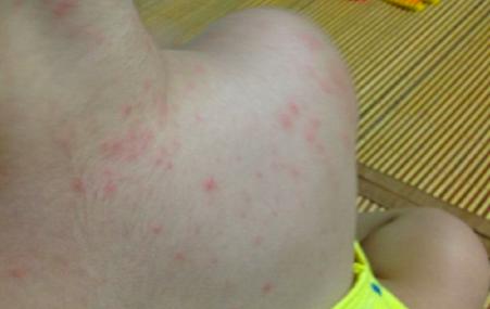 夏秋交替，很多妈妈来咨询，宝宝起了痱子，该怎么办？

今天就给宝妈们支几招。#0