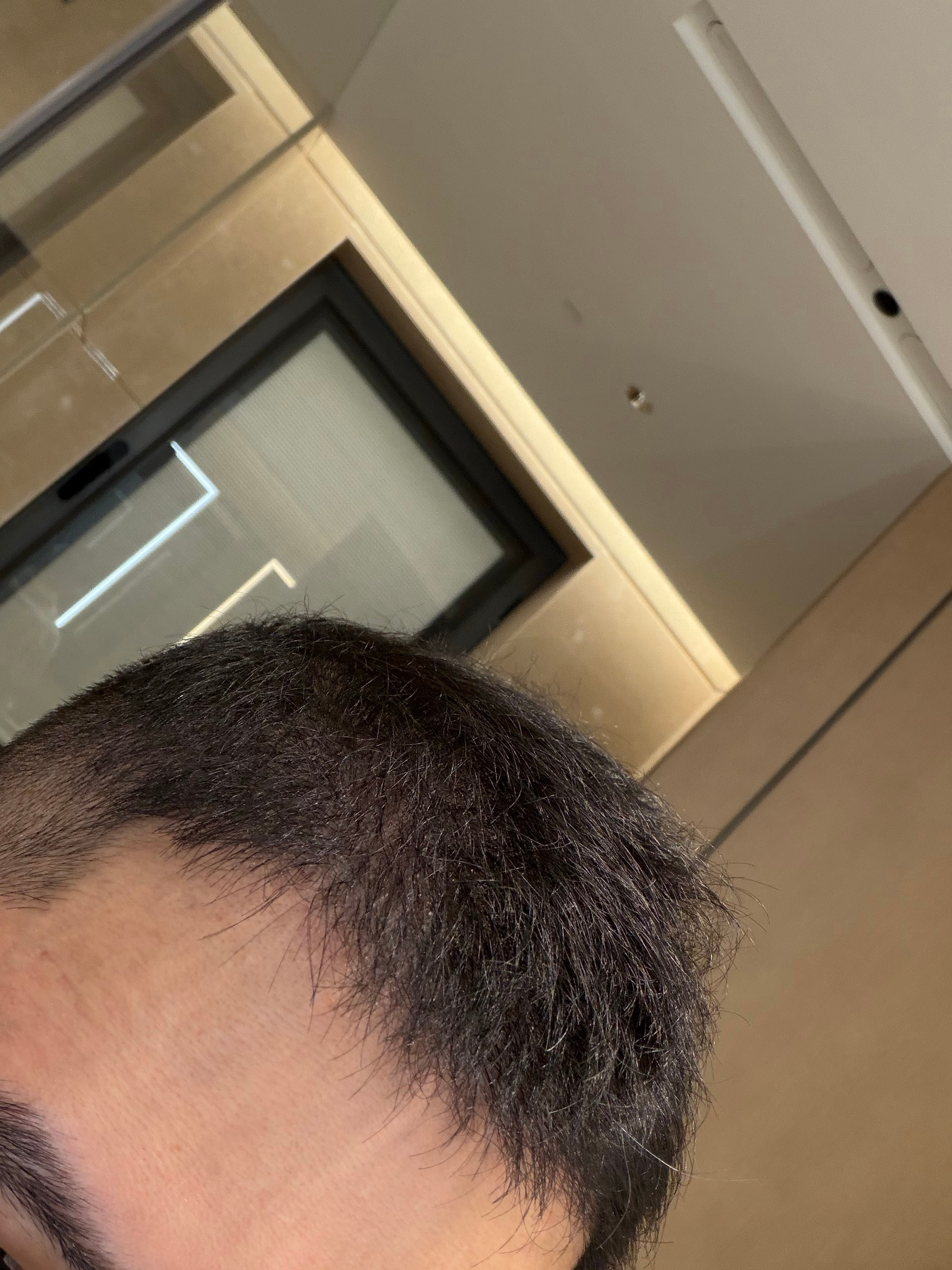 plla对毛囊的作用真的没人研究么？毕竟这个月以来真的很炸毛而且我头发从小很细很
