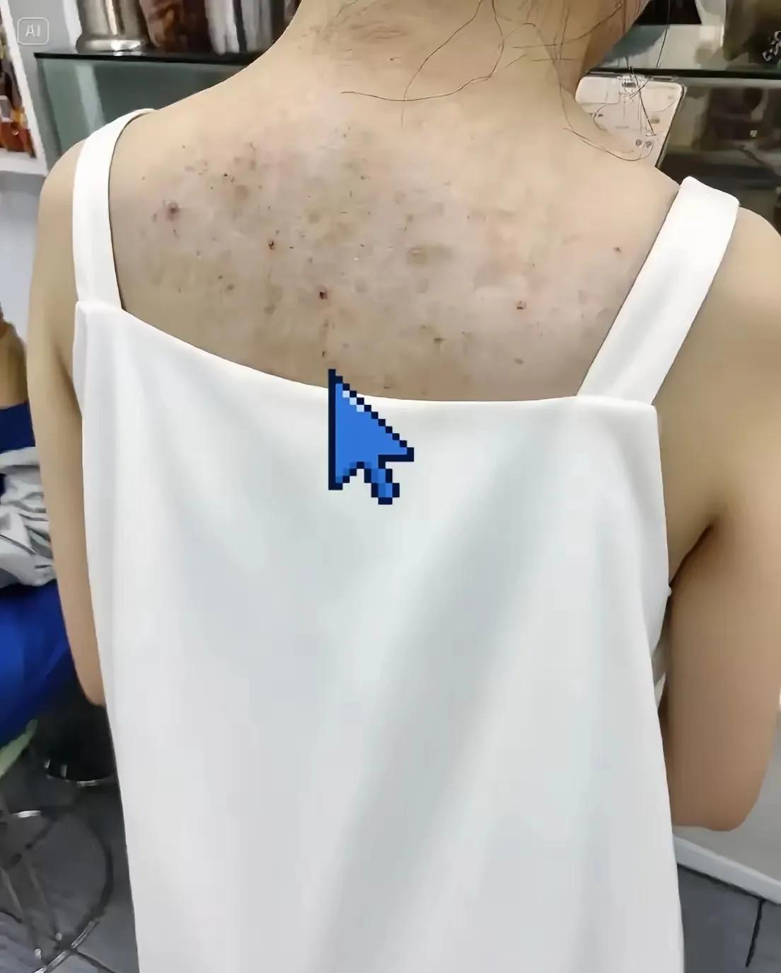 吊带美女后背上这是啥东西？看着有黑色素沉淀，还有好几个小痘痘。这是在头条上看到的