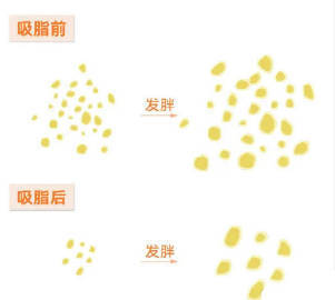 吸脂术后会不会反弹？ 吸脂 身材管理 减脂塑形 成年后脂肪细胞数量基本恒定，被抽