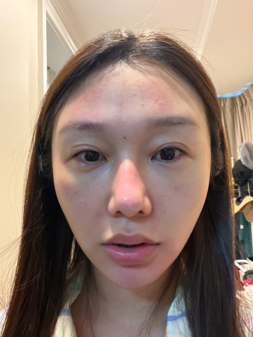 我呢妈糟了 又过敏了 ​​​