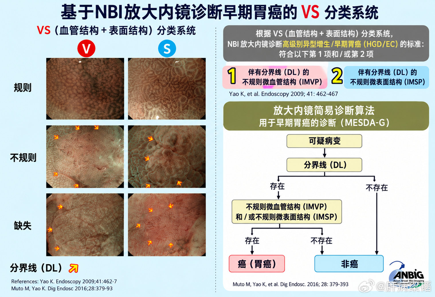 ME-NBI胃早癌VS分类 ​​​