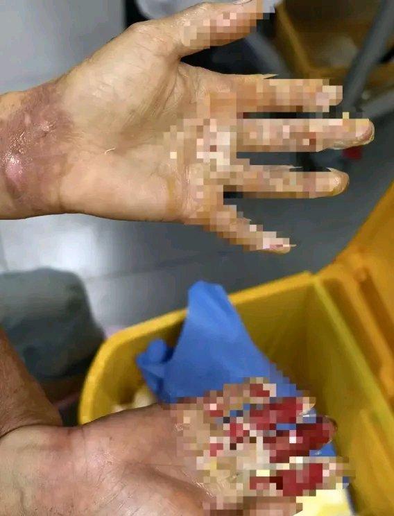 太痛心了！10月16日晚，四川攀枝花3岁男童钟宇在餐馆吃饭时，不慎踩到炭火堆中。