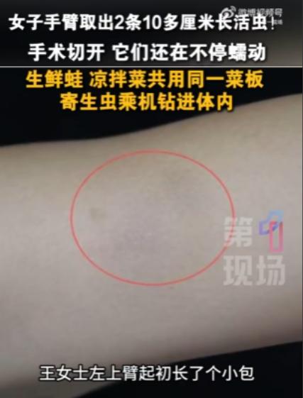 “想想都头皮发麻！”广东深圳，一女子一年前手臂上莫名冒出个包块，不痛不痒，她也就