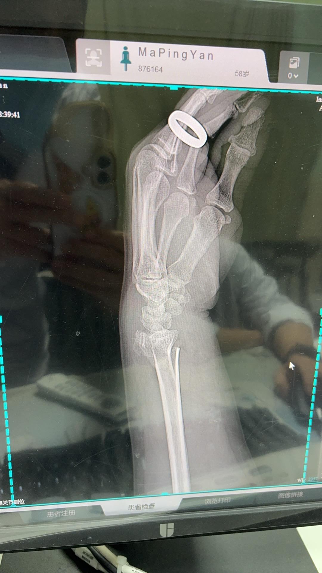 传统的骨科复位手法还是蛮有用的