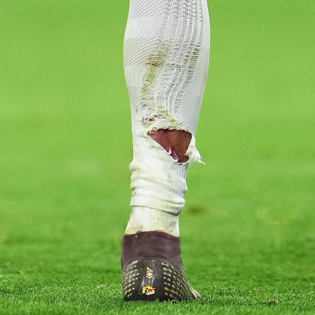 姆巴佩的腿被对手鞋钉踢到🤕 