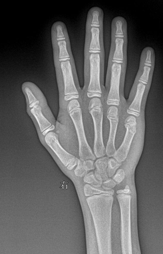 男 13y 外伤 右手正斜位