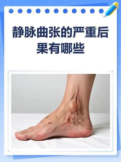 我发现不少中老年人腿上血管弯弯曲曲凸出来，不痛不痒就完全不在意，总觉得只是上年纪