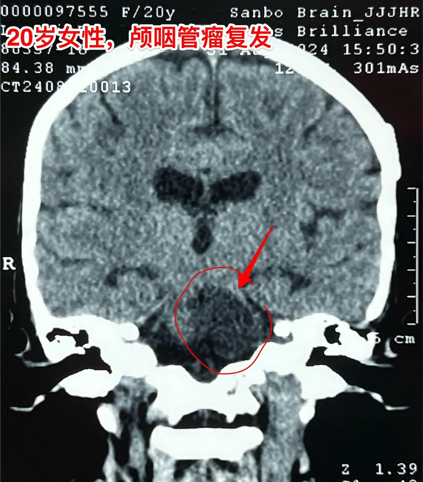 颅咽管瘤第七次开颅手术，恢复顺利。20岁女性，广东省东莞人。不幸的孩子...