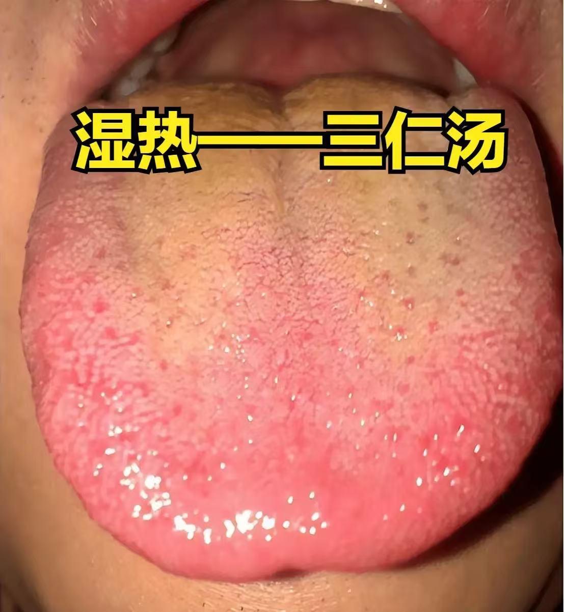 中医界祛湿最快的三把刀，一把专攻湿热，一把专攻寒湿，一把专攻痰湿，学会一个都不吃