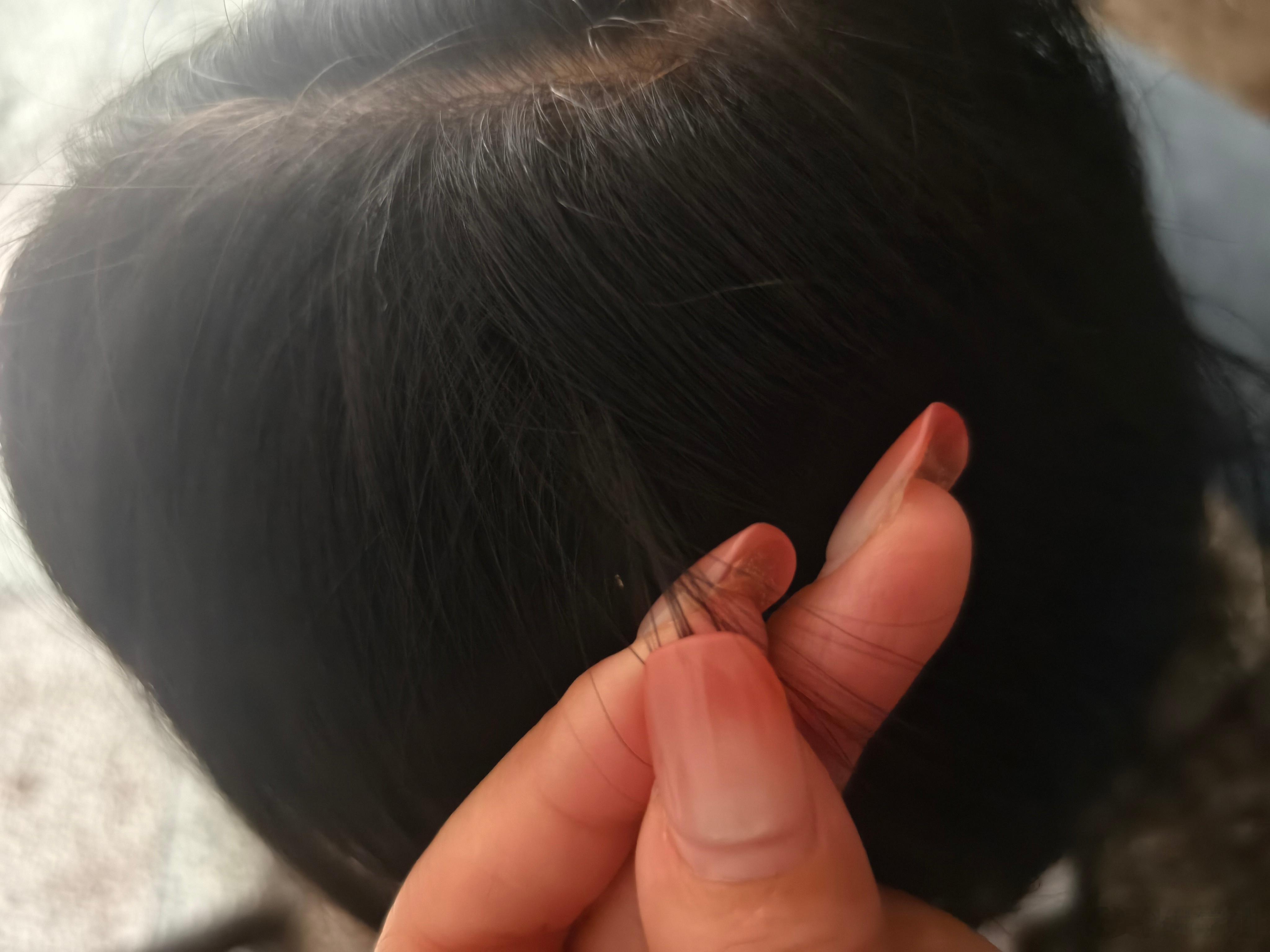 她老师说这个白色的是虱子卵，我就觉得奇怪，从放暑假到现在已经好久了，是虱子卵的话