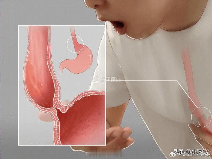 22岁的广东姑娘小林，吃饭这件平常人眼里最幸福的事，对她来说却像一场漫长的“酷刑