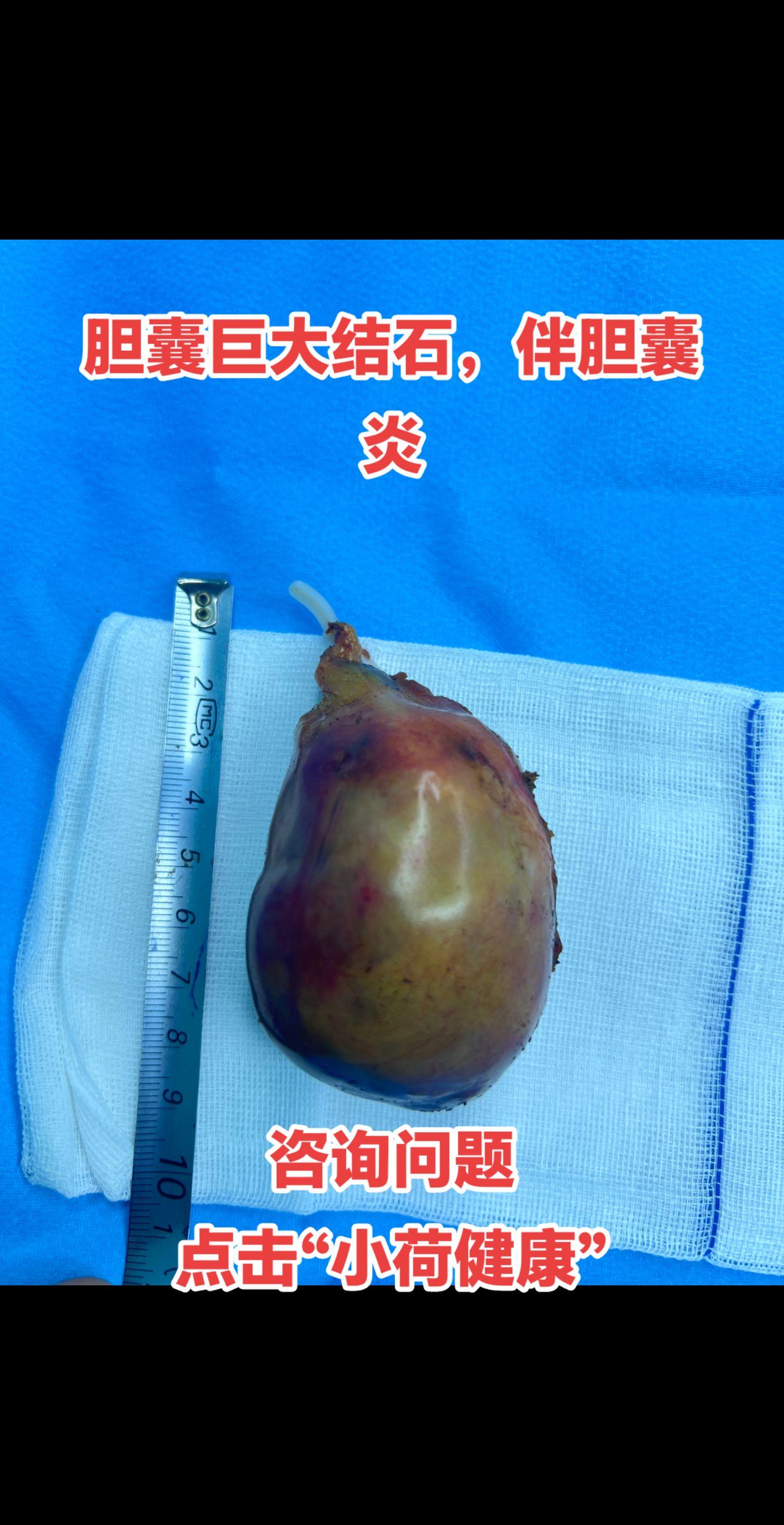 胆囊巨大结石。