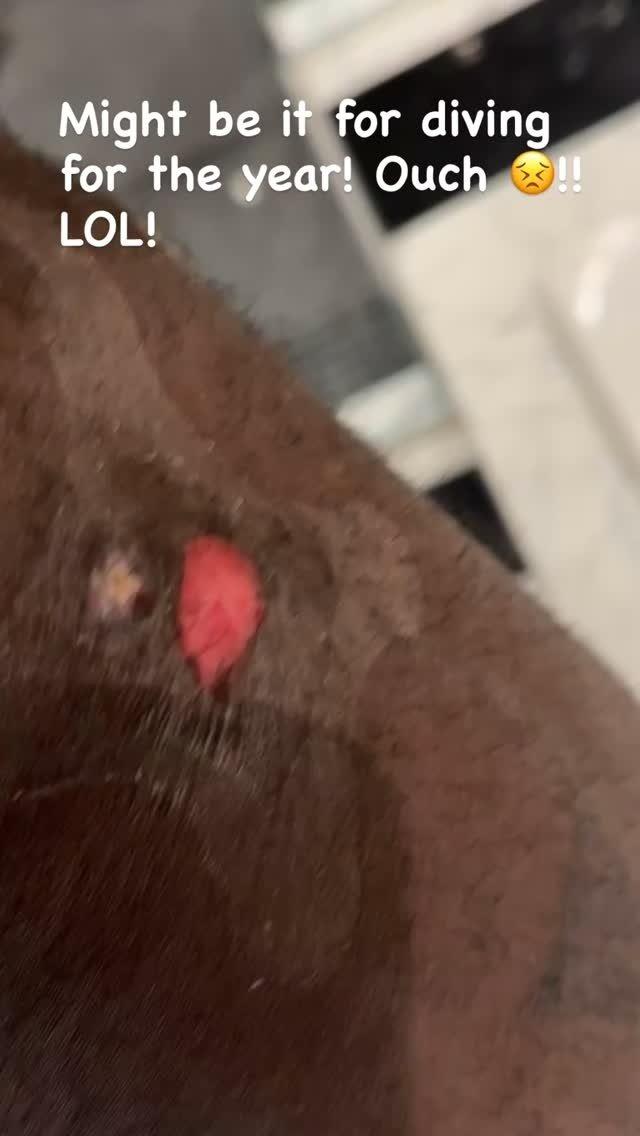 詹姆斯晒鱼跃救球伤口  詹姆斯晒出他右腿上一处已经皮肤破损的伤口写道：“也许是因