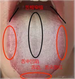 这样的舌头啊，就是经典的“虚不受补”的舌象，千万别盲目吃补药；
患者主诉：精神不