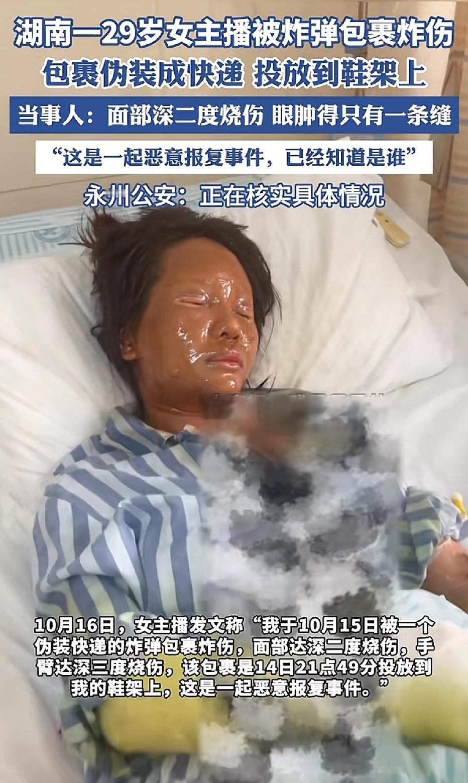湖南永州一位29岁的女主播被“炸弹”包裹炸伤，面部呈深二度烧伤，眼睛肿成了一条缝