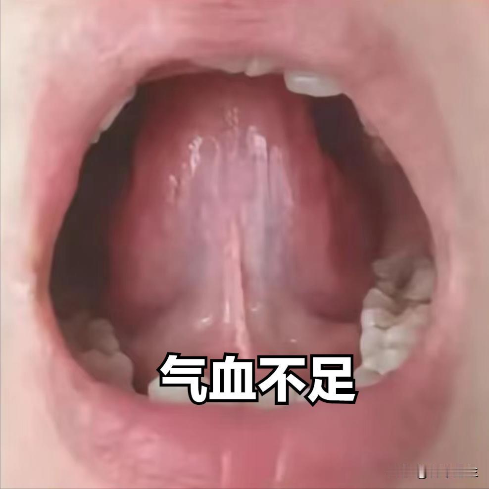 四种舌下经脉体现四个疾病，来看看你中招没

1. 寒邪凝滞
可以看见舌下脉络呈淡