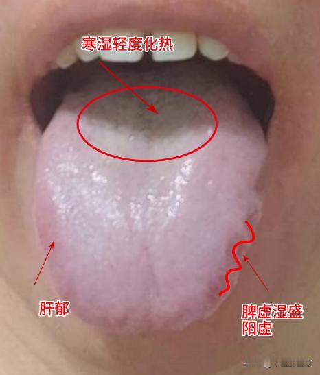 舌苔白腻 生活差 口腔异味 耳鸣 不适合直接补 要先疏通
我们来看这个舌苔，整体