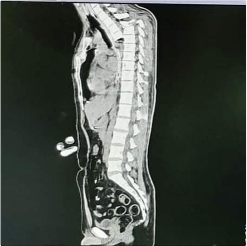 摩托车事故的后果

脊髓横断，脊髓是传入感觉信息和传出运动命令的主要中继站。有多
