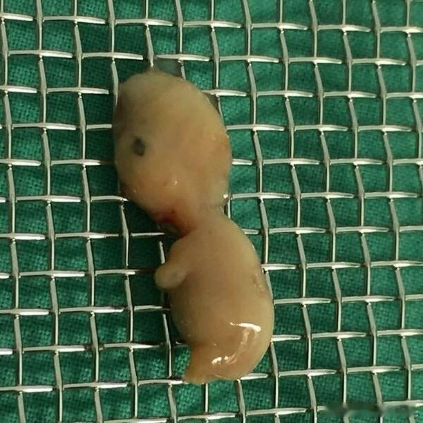 Miscarried fetus at 9 weeks old!!A misca