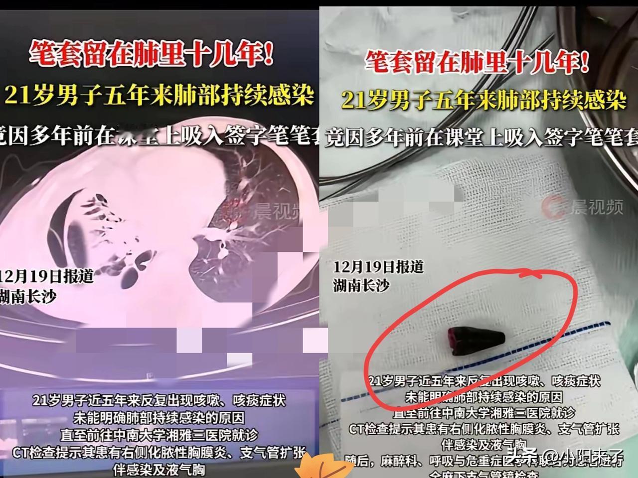 “心怎么这么大！”湖南长沙，一男子近5年来，反复出现咳嗽、咳痰的症状，刚开始没有