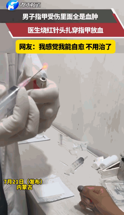 十指连心！内蒙古一家医院诊室里，一男子手指头不知道遭了什么罪，整片指甲盖下面全是