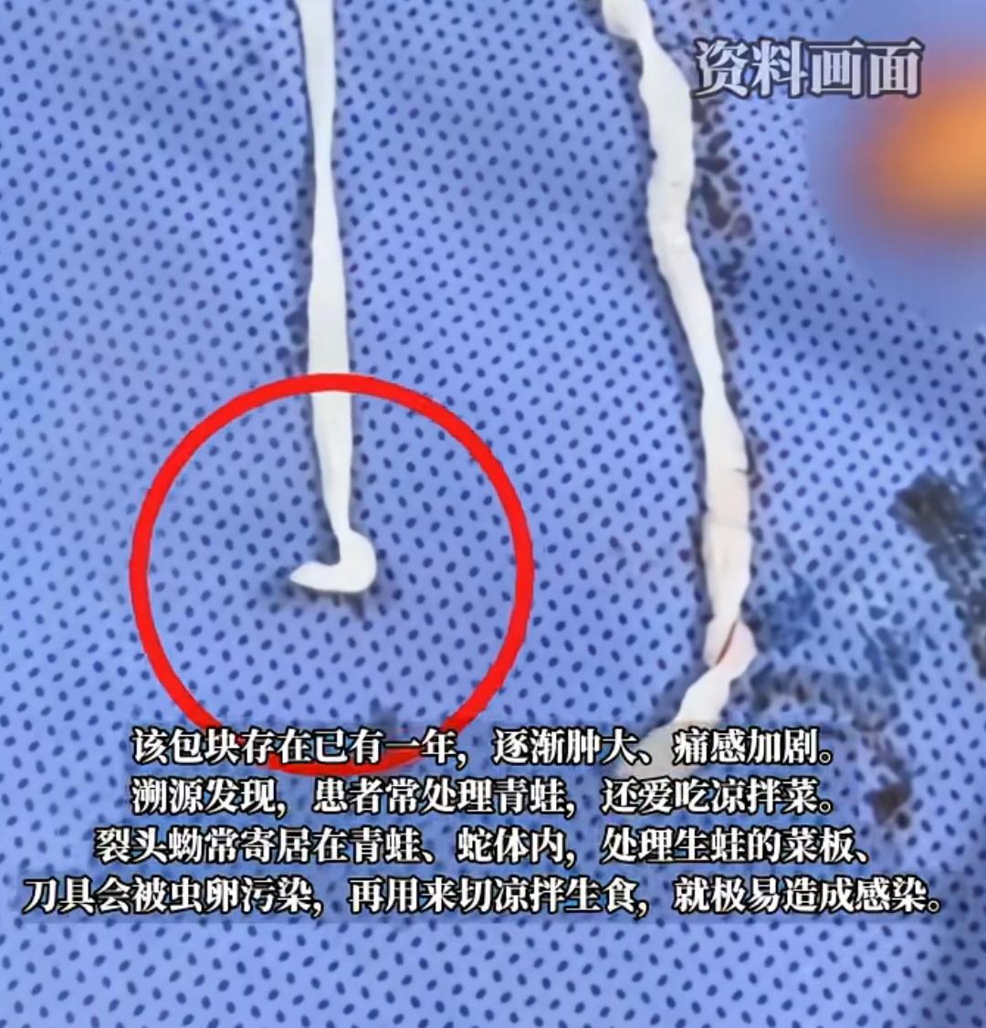 女子手臂长包一年后就医，医生怀疑血管瘤切开后竟钻出两条10多厘米的活虫。医生称，