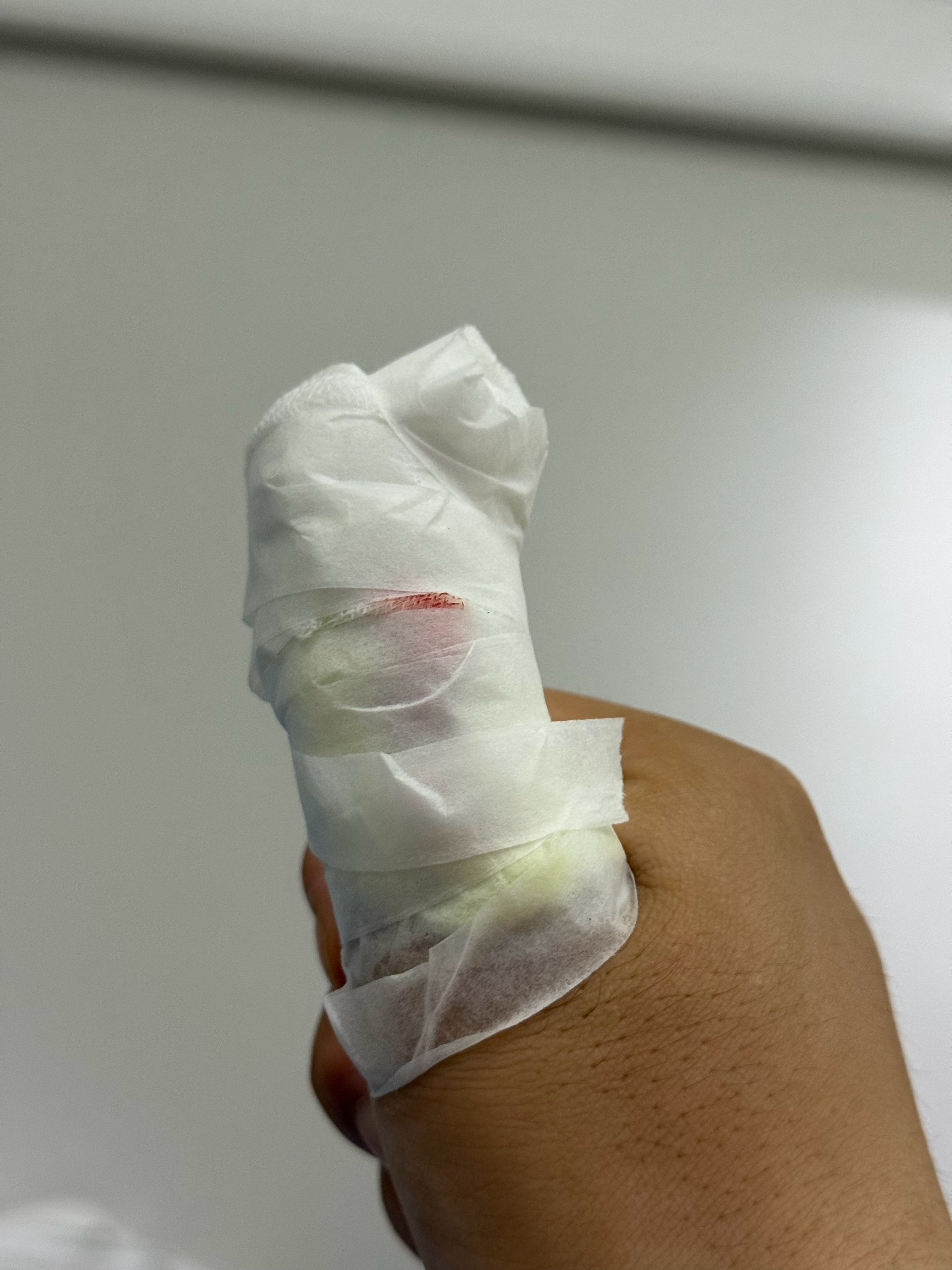 刷杯子，突然崩碎了一个口，剜掉一块肉[允悲]太惨了。。。 ​​​