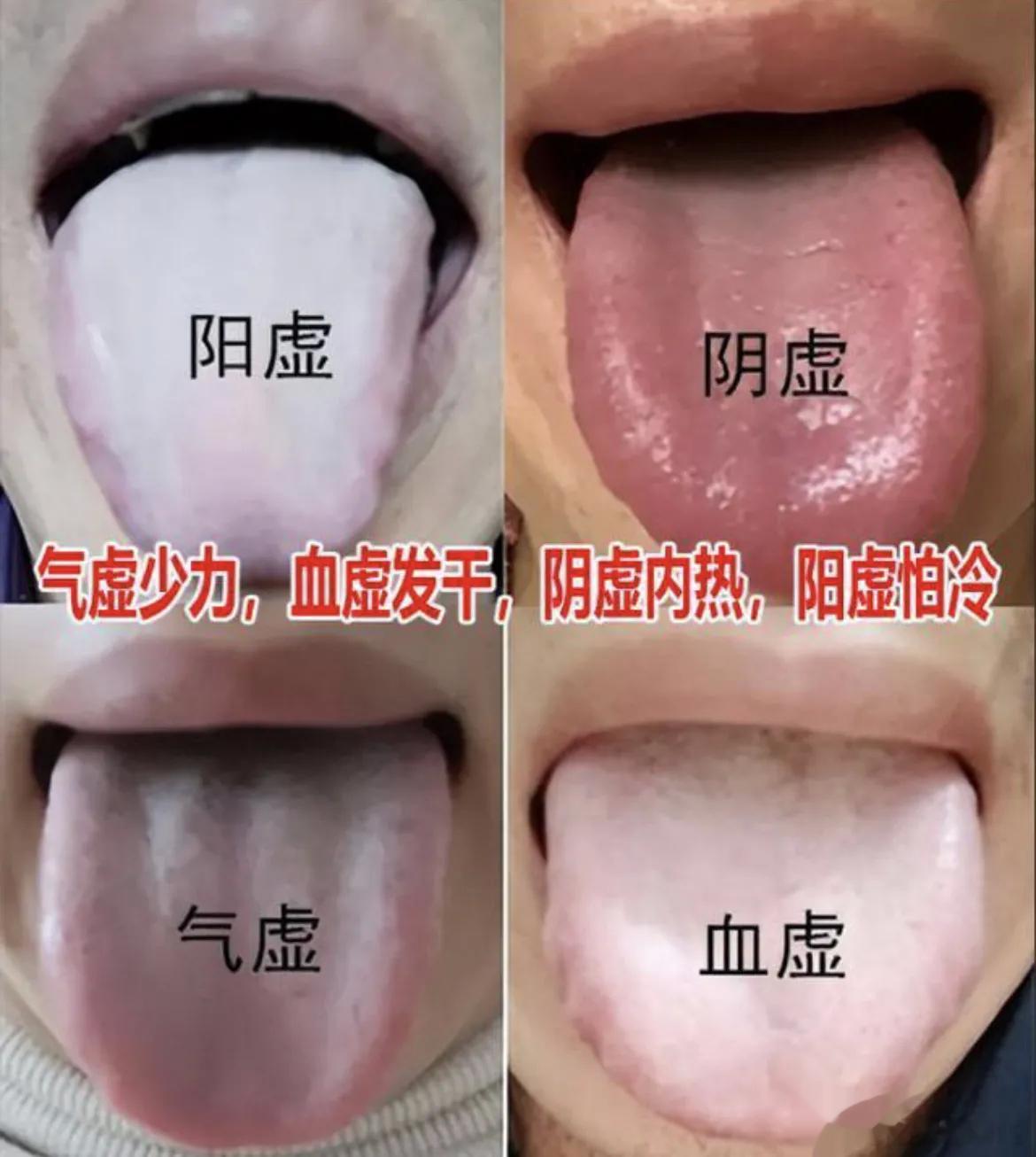 想知道自己是哪里虚？看完你就明白了1、气虚——气虚的最典型的症状就是累，很多人都