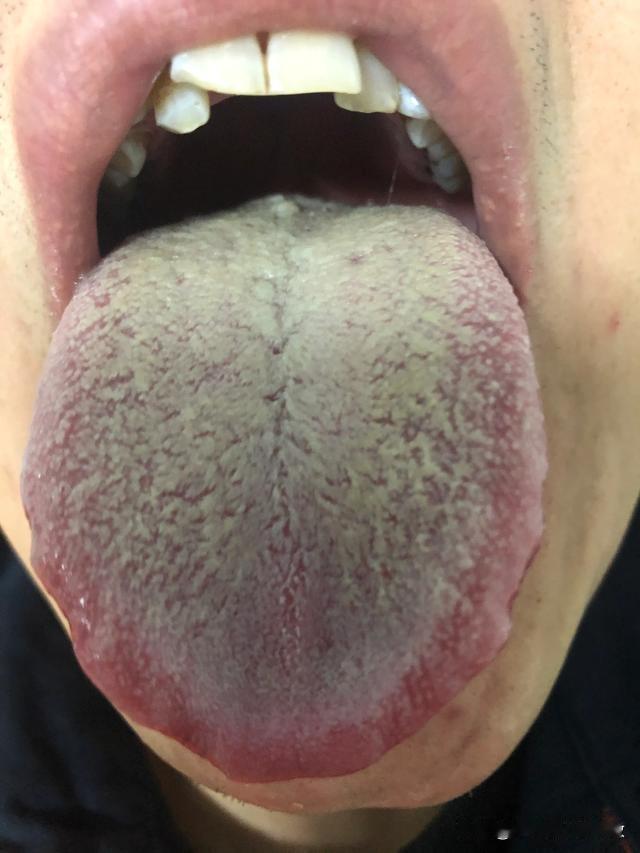 看到这样的舌头，说实话，我头都是大的[吃瓜群众][吃瓜群众][吃瓜群众]
主诉：
