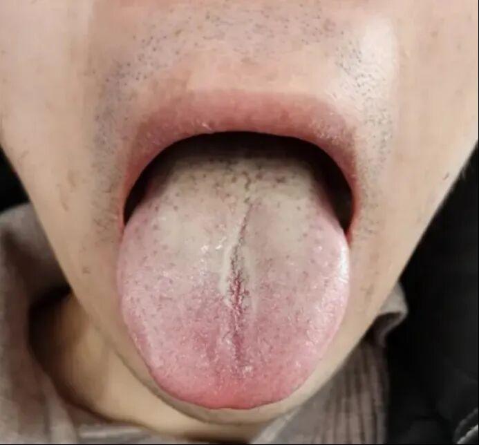 舌中间这么明显的裂纹 可不是肝和肾的问题 主要在脾胃
许多人在看到这种舌象时，可