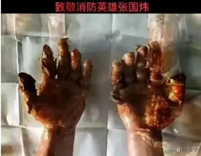 请不要质疑，这就是消防英雄的手，曾在火场救出7名群众。
他就是消防员张国炜，19