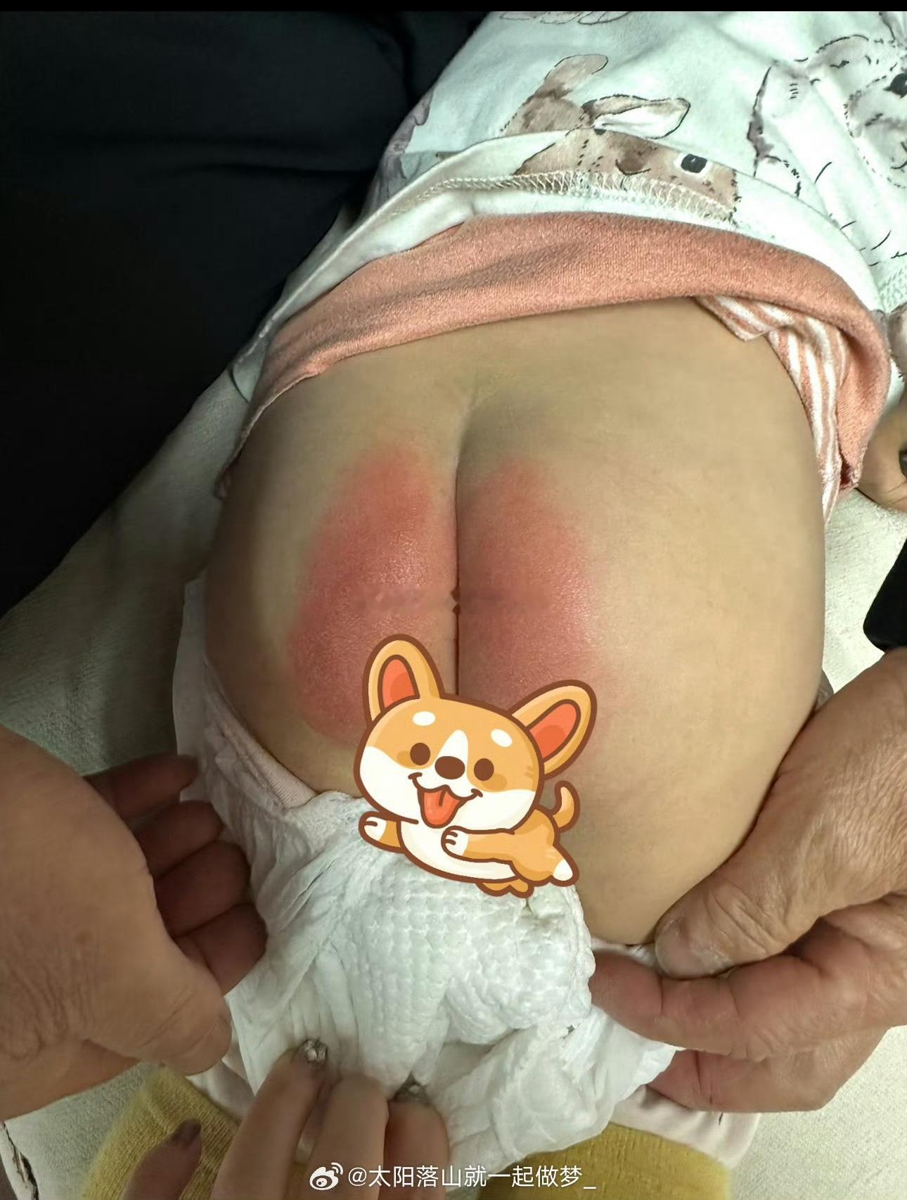 已买Babycare纸尿裤两年家长发声受害小朋友的屁股大家看看什么情况，这是去年