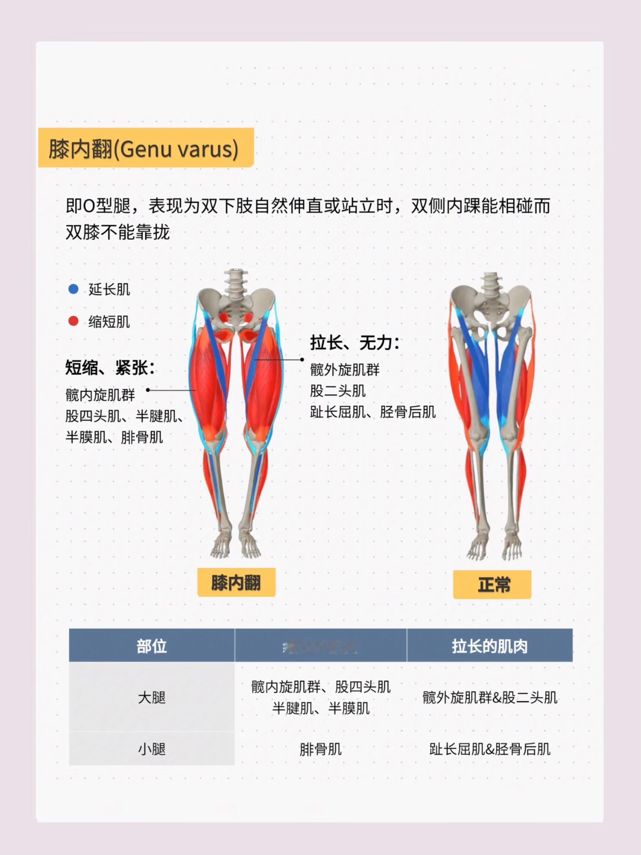 有腿型困扰的人有救了除了骨性结构导致的腿型无法改变⚠️其它的问题都是由于肌肉张力