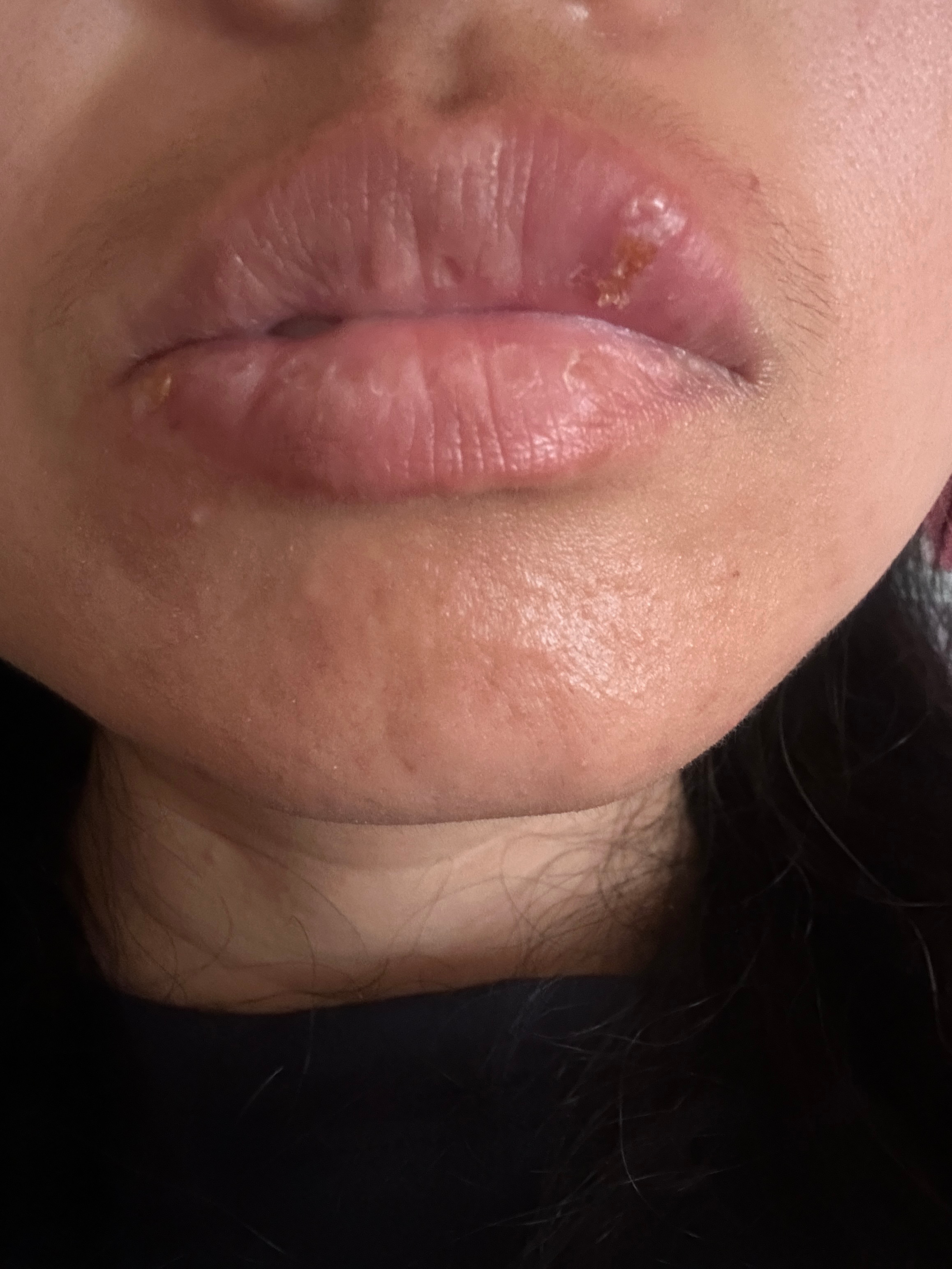 我的身体就是时节养生表。小满饮食原则我上火了，上唇和下唇角各起了一个火疮，原来是
