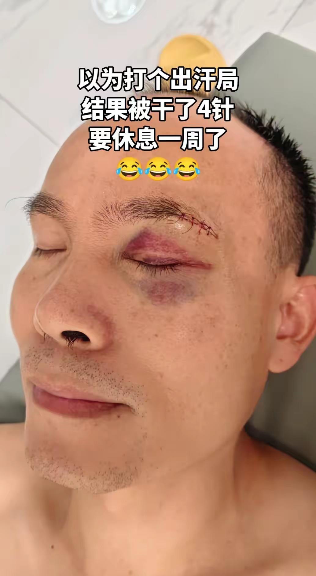 打篮球眼角被打爆缝了4针。