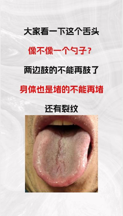 看这个舌象，像不像一个“ 勺子 ”？舌两边鼓胀的不能再鼓了，同时身体也是堵的不能