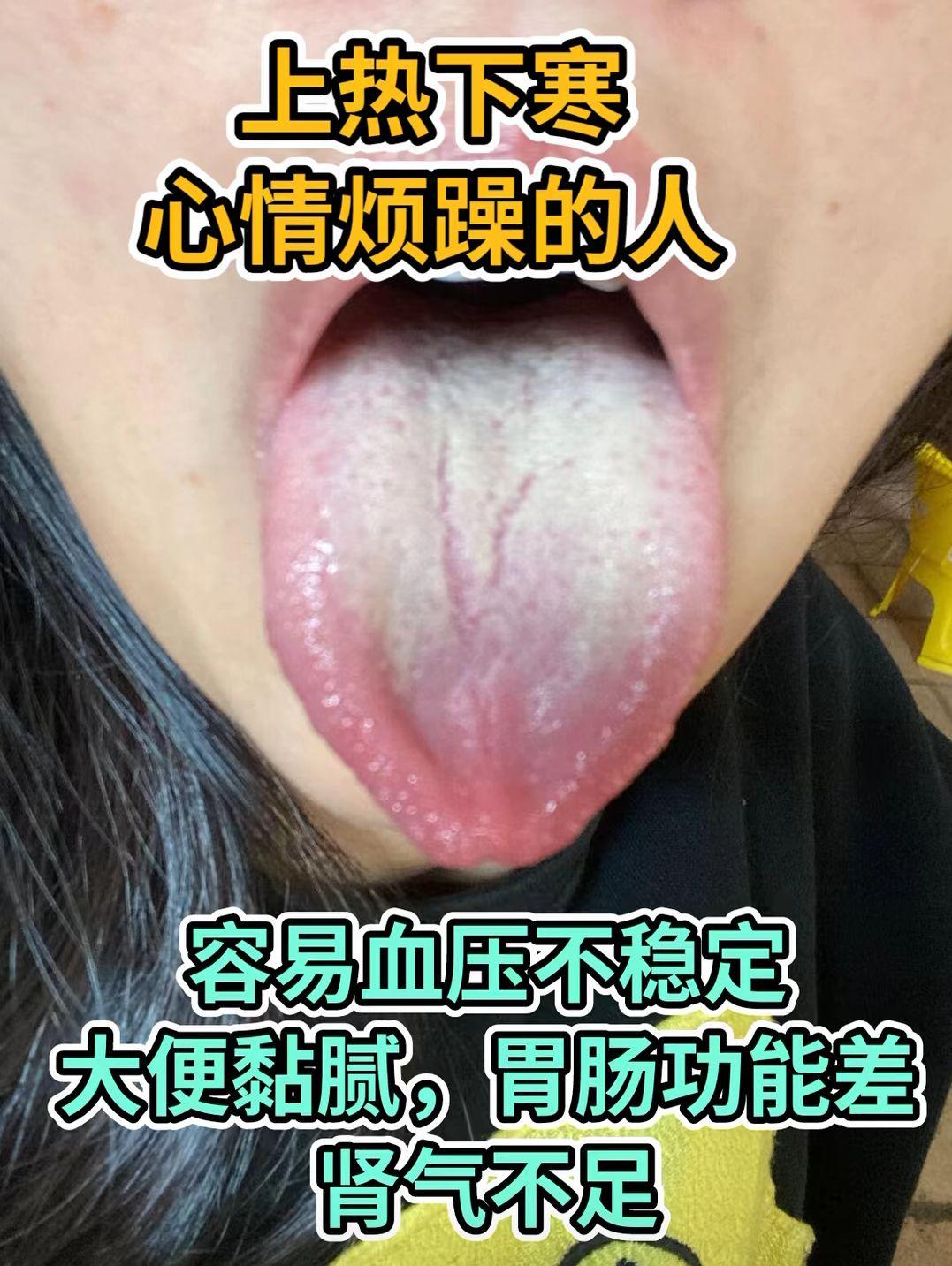 一日一舌象分析 看看你是哪种