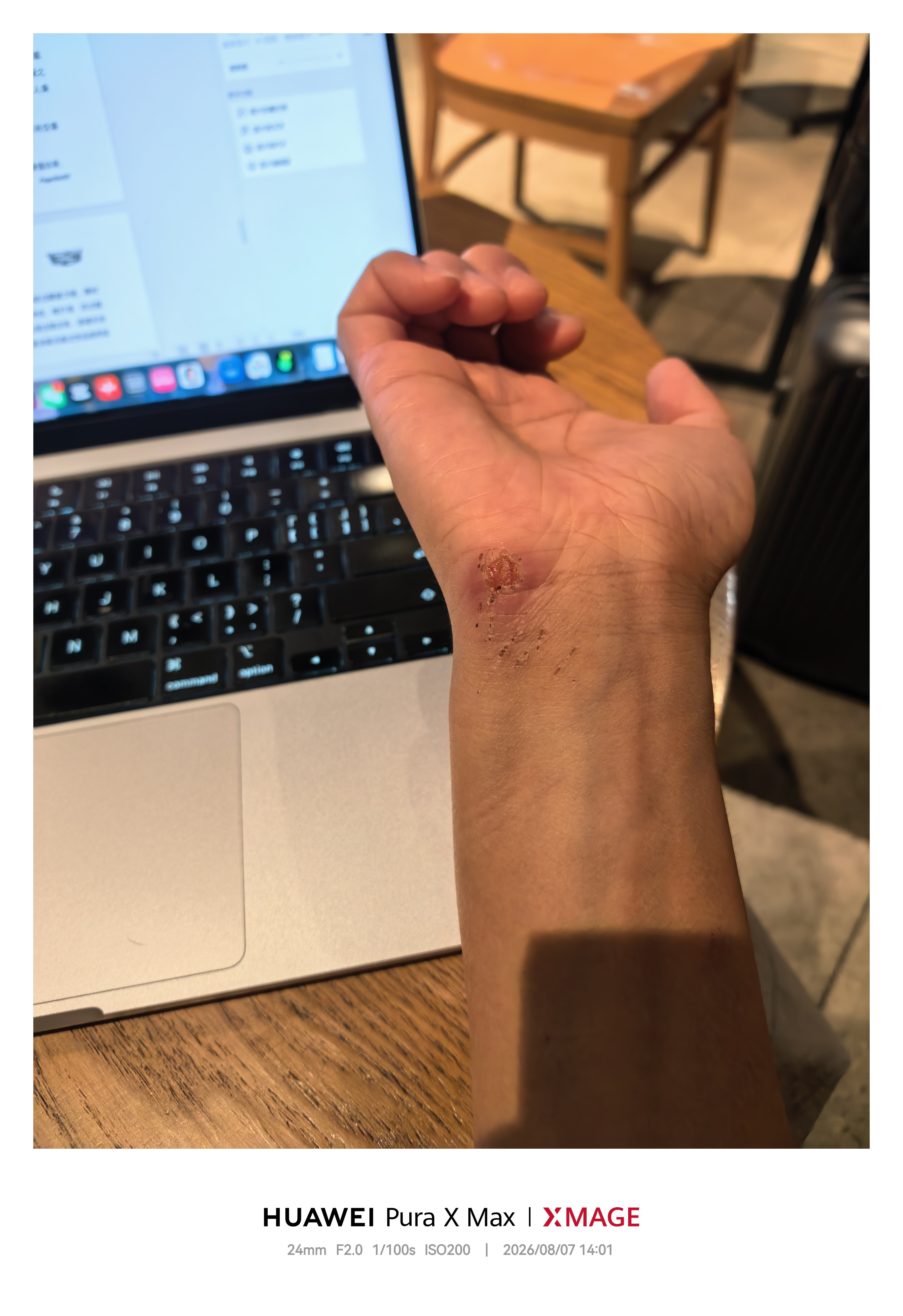 前几天掉海里，摔到手肘处。划伤的位置正好是放在电脑掌托的支撑点，每次打字都磨到，