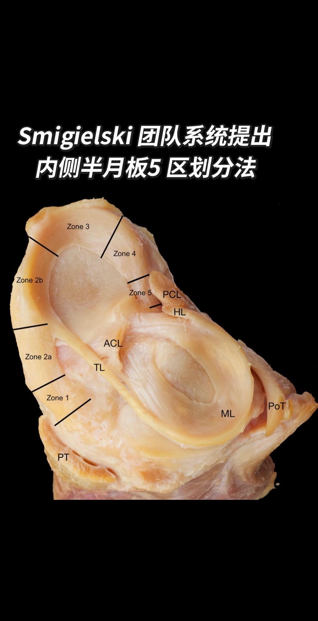 内侧半月板“五区”划分法！“Smigielski 等于2015年在 E...