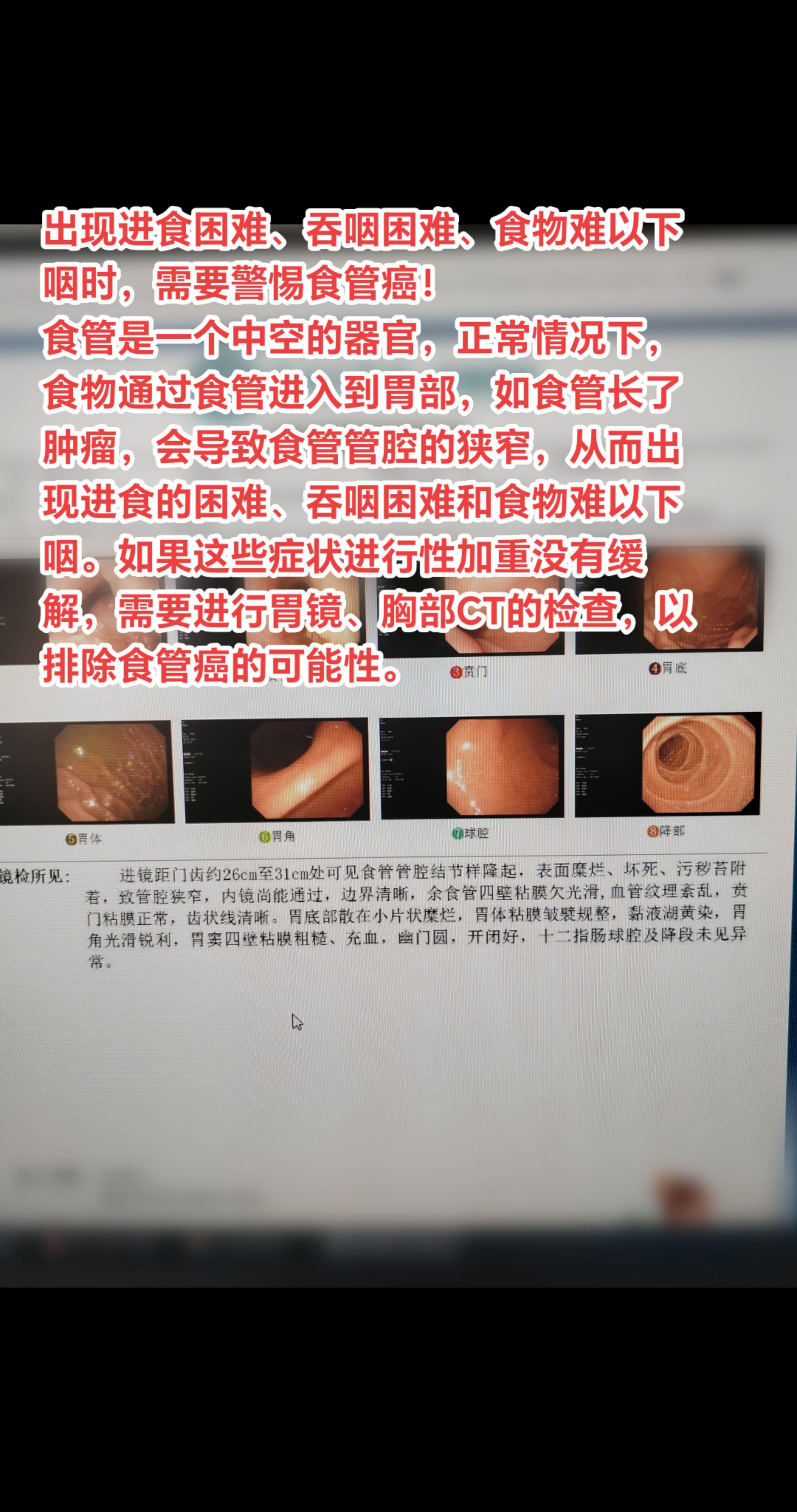 吞咽困难、食物难以下咽时需警惕食管癌。食管是一个中空的器官，正常情况下...