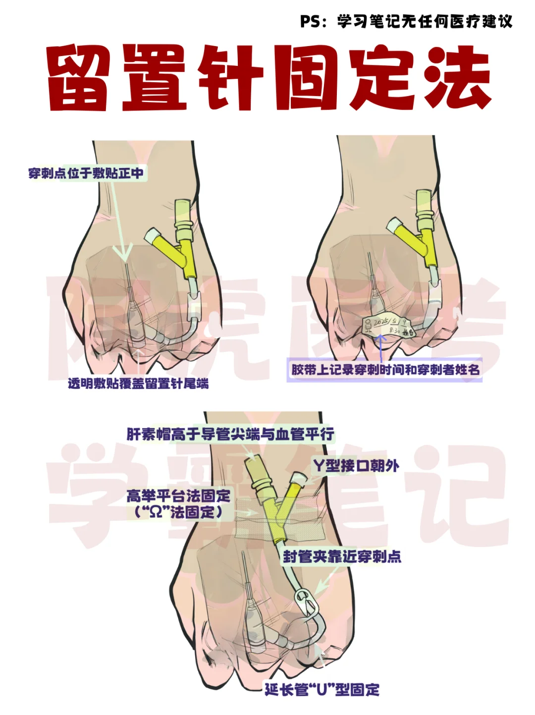 医学生笔记📒：图解留置针固定法👆