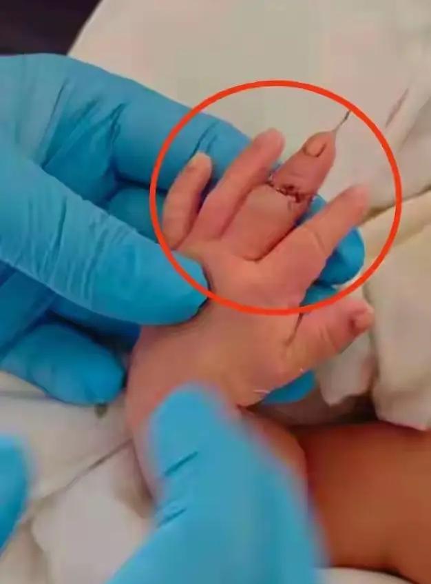江苏盱眙新生儿被助产护士剪断手指这事，看的真是后背发凉，剪脐带能把手指剪断，反过